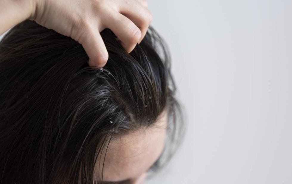 do bald people get dandruff