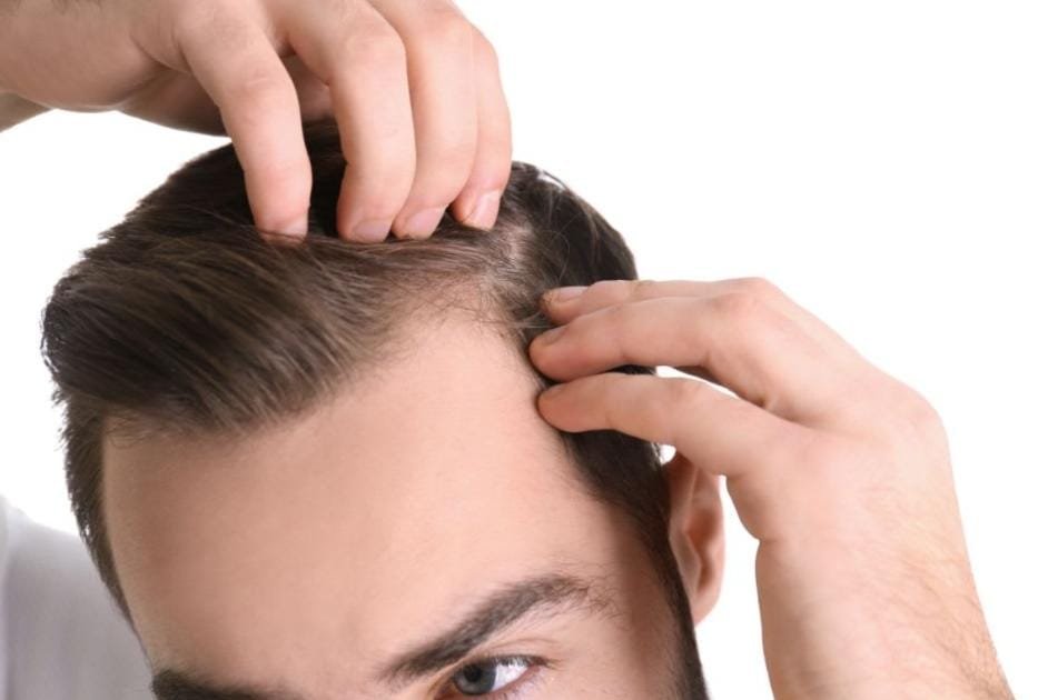do bald people get dandruff