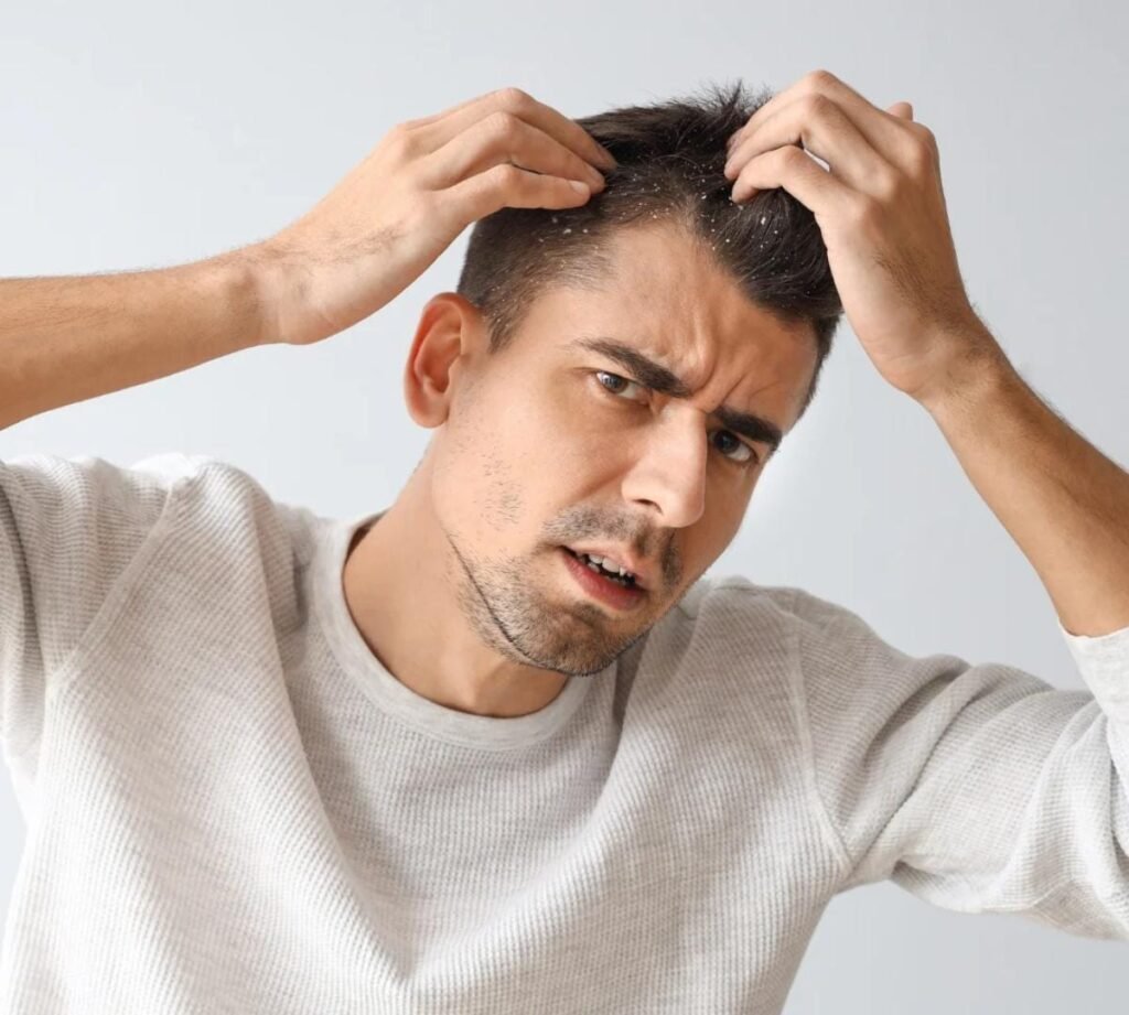 do bald people get dandruff