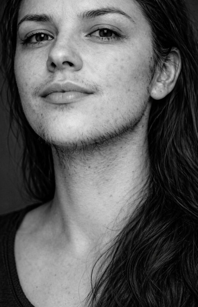 polycystic ovaries hair on chin