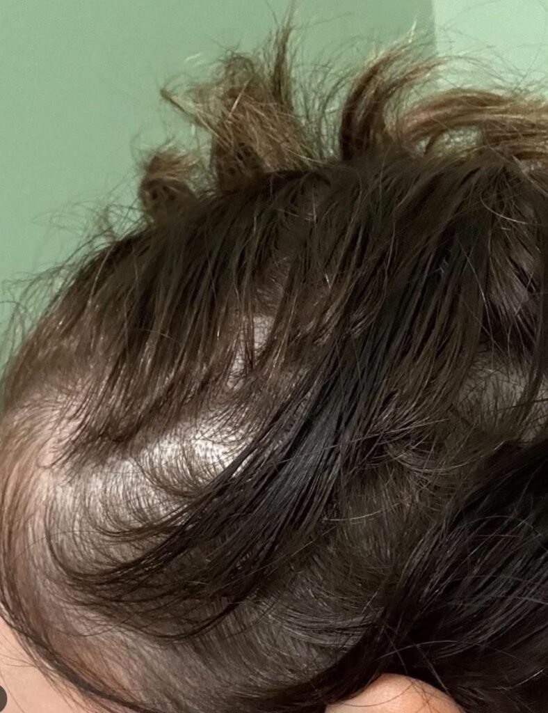 zepbound and hair loss